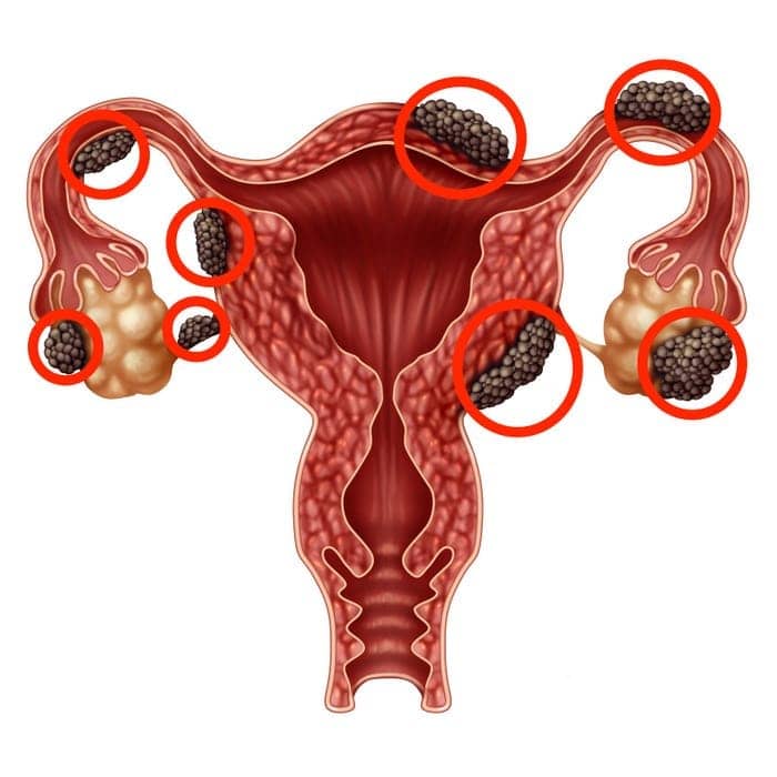 Endometriozis: Tanı zorlukları, yaşam kalitesi ve tedavi yöntemleri